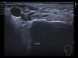 ultrasound filler tear trough